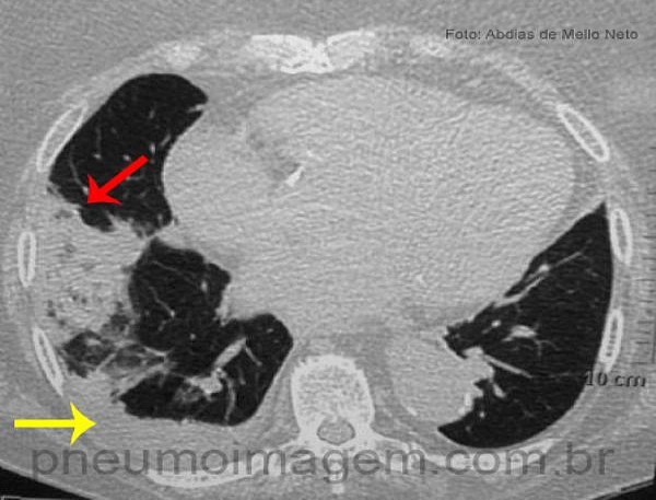 NOVAS DIRETRIZES SOBRE EMBOLIA PULMONAR: FAÇA O DOWNLOAD NOVAS DIRETRIZES SOBRE EMBOLIA PULMONAR: FAÇA O DOWNLOAD